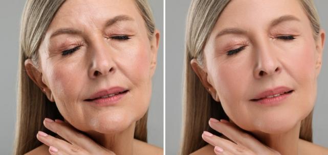 Injection d’HarmonyCa Injection d’HarmonyCa